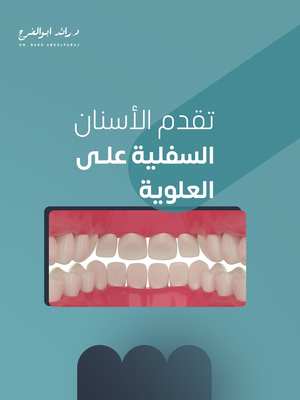 Underbite Dental Design